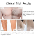 StarGlow™ Infinity Laser – 990K Flashes Hair Removal System - STAR CARE