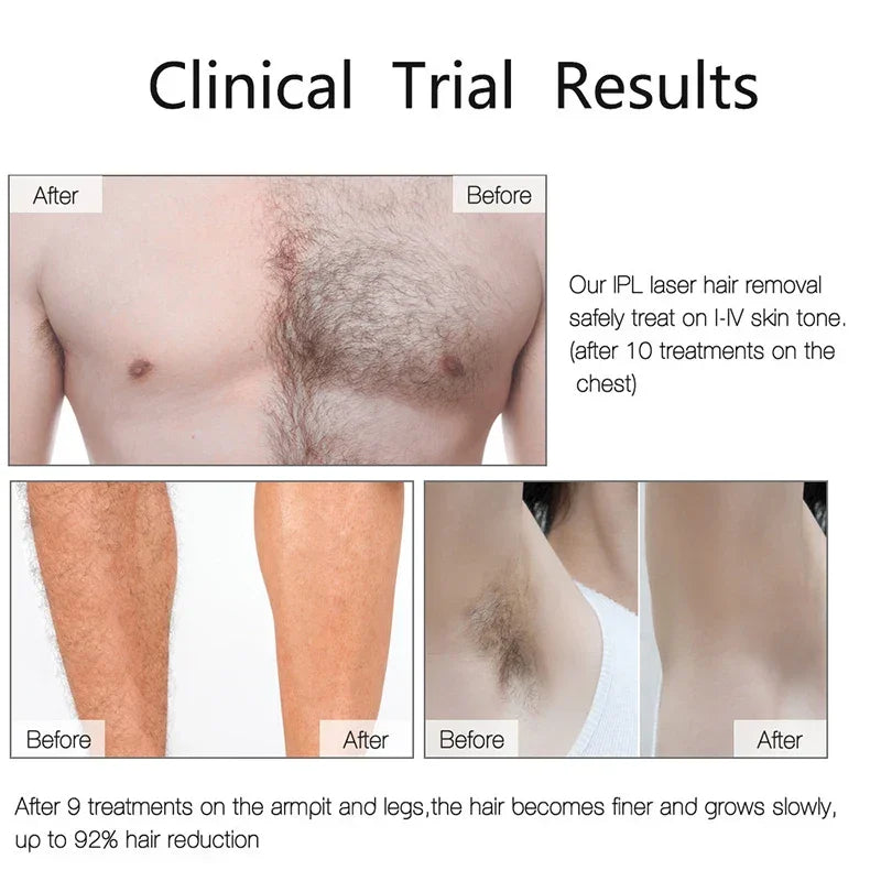 StarGlow™ Infinity Laser – 990K Flashes Hair Removal System - STAR CARE